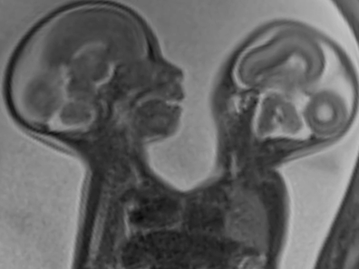 How are the Altobelli conjoined twins doing today? All the details 