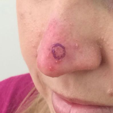 Lauren from Married At First Sight shares skin cancer photo