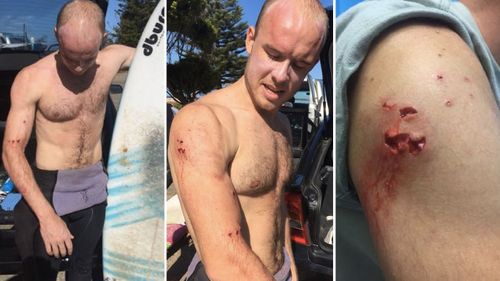 Charlie Fry shows the marks on his arm after he was attacked by a shark on a NSW beach. (Supplied)