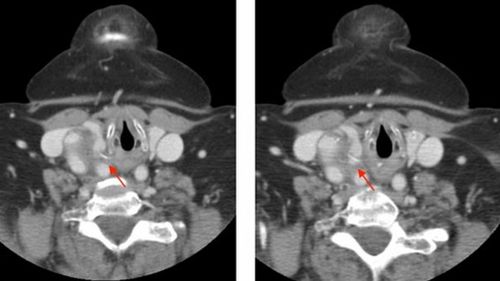 The bone was just millimetres from the woman's carotid artery. (BMJ Case Reports)