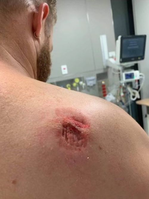 A security worker at Port Macquarie Base Hospital has a deep bite wound on his shoulder.