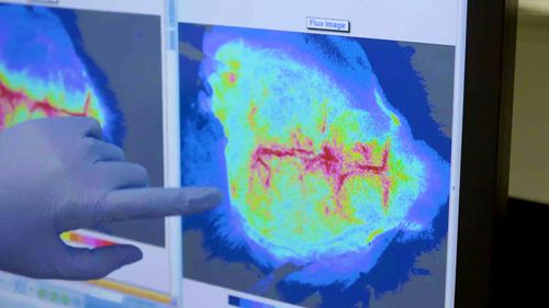 Début des essais cliniques pour un nouveau médicament anti-coagulant pour traiter les AVC.