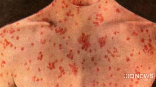 Measles is highly infectious and is spread through the air by those who are infected. (9NEWS)