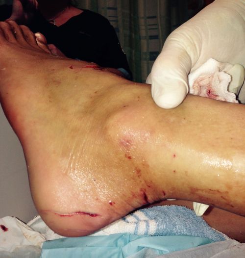 Kirra-Belle Olsson's foot after shark bite. (Supplied)