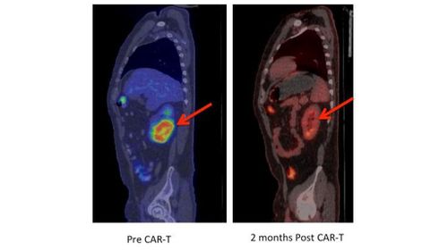 "This is a regression of chemotherapy-refractory lymphoma after CAR T-cell therapy. Positron emission tomography (PET) images showing large tumor mass in the kidney (red arrow) prior to CAR-T cell therapy that completely regressed on a repeat PET scan performed 2 months after CAR-T cells." (Fred Hutchinson Cancer Research Centre)