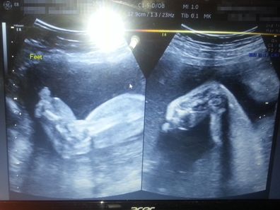 This sonogram image showed the swelling in Mia-Rose's legs and feet before she was even born.
