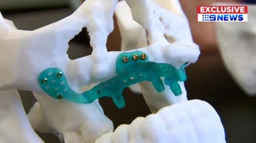 The 3D printed jaw.