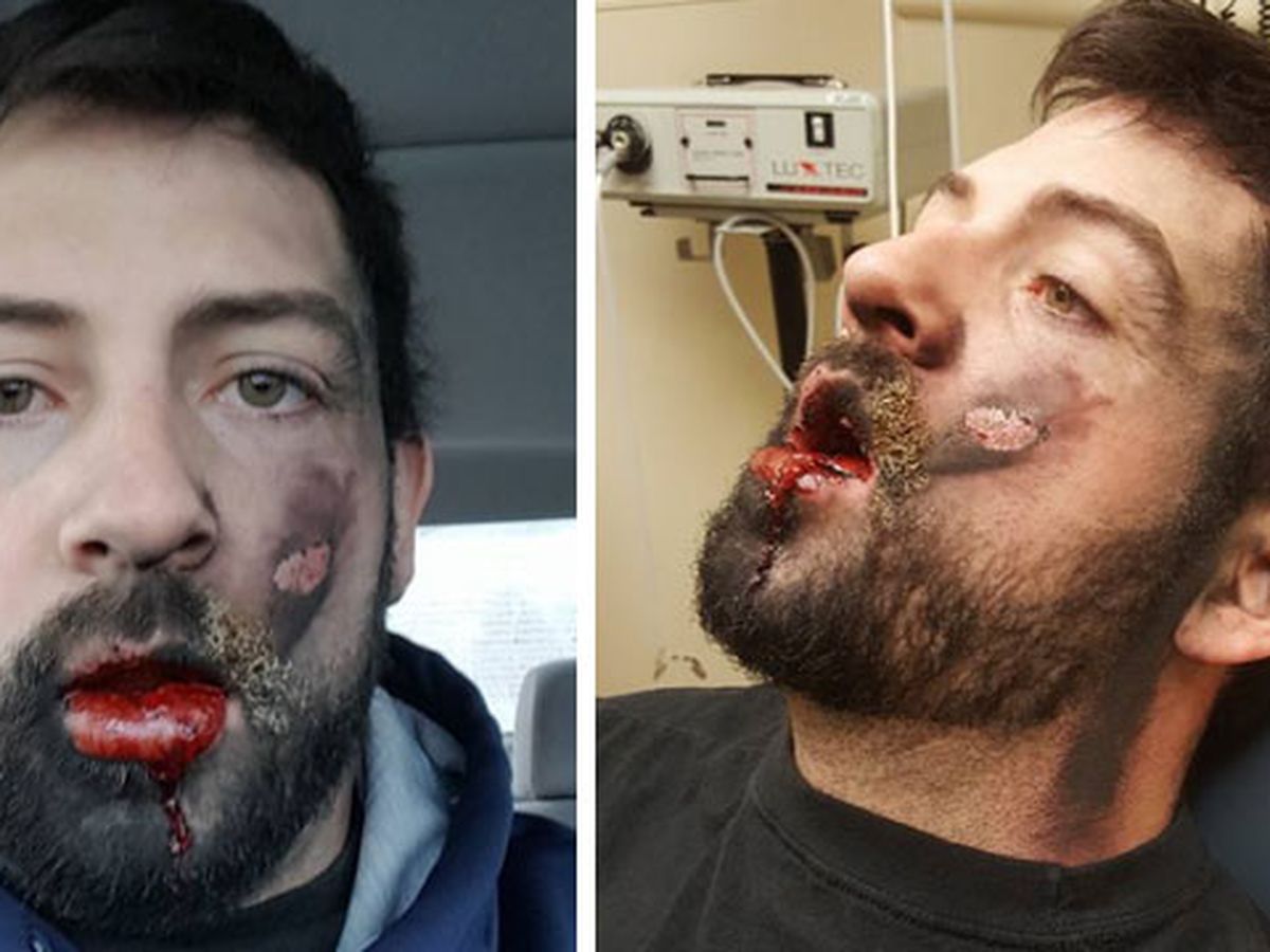 US man left with devastating injuries after e-cigarette explosion
