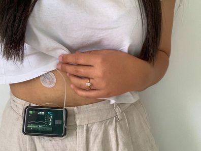 Emily Vilé shows the insulin pump on her stomach.