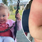 Days after rash appeared, Allegra had to have organ removed