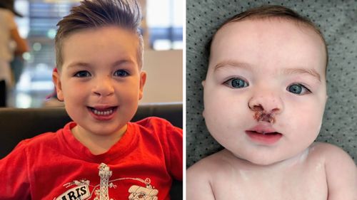 'Give them a fair go': Children with cleft lip and palate missing out on speech pathology