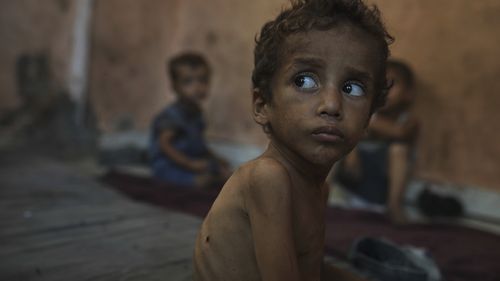 Yazan Abu Ful, a 2-year-old malnourished child, sits at his family home in the Shati refugee camp in Gaza City on Wednesday, July 23, 2025. (AP Photo/Jehad Alshrafi)