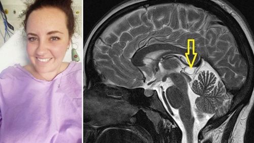 Sarah Jackson and (right) an MRI scan showing the cyst on her brain.