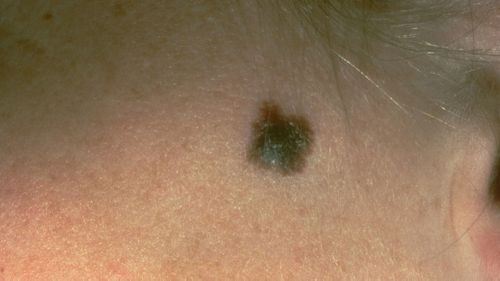 This photo, provided by the American Academy of Dermatology, shows a typical presentation of a suspicious mole that eventually was diagnosed as melanoma. 