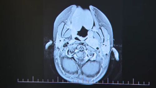 The tumour inside six year old Freyja's head. (9NEWS)