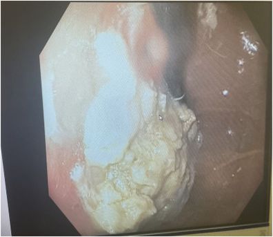 Endoscopic image of the chewing gum bezoar.