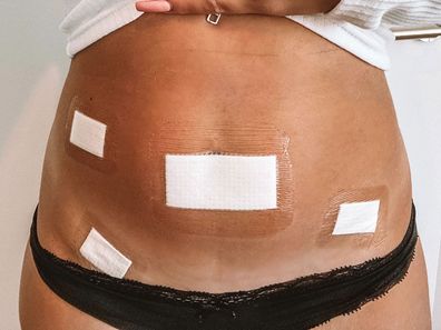 Surgery for endometriosis has left Ella Collings with scars on her stomach. 