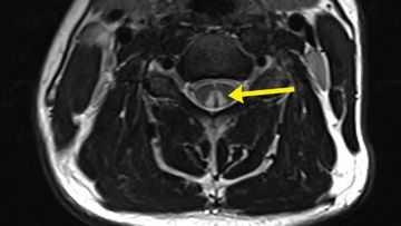 The inverted &quot;V&quot; sign as shown in this medical scan is evidence of spinal damage through nitrous oxide use.