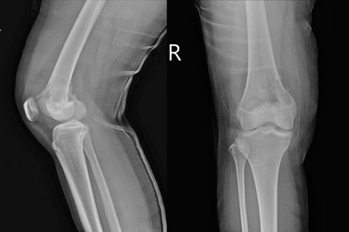 An X-Ray showing an osteosarcoma on a knee.
