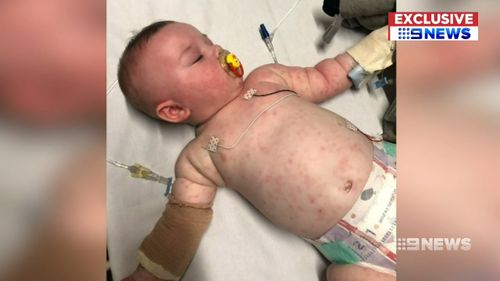 Just days ago, six-month-old Oliver was fighting for his life after being struck down with Meningococcal B.