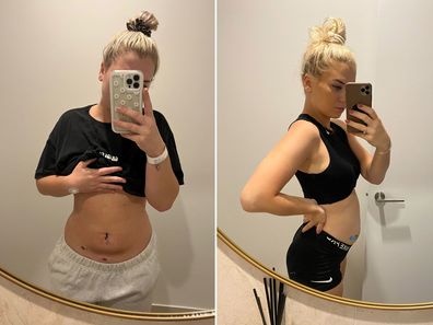 Surgery for endometriosis has left Ella Collings with scars on her stomach. It often leaves her severely bloated as well.