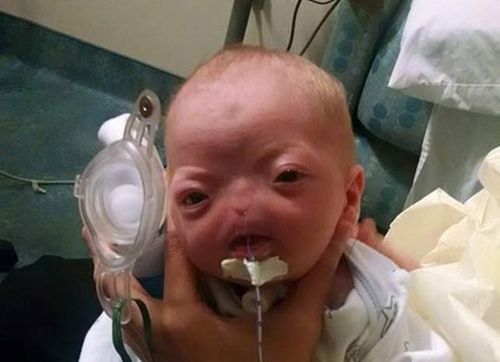 Baby born without a nose one of only 37 known cases worldwide 