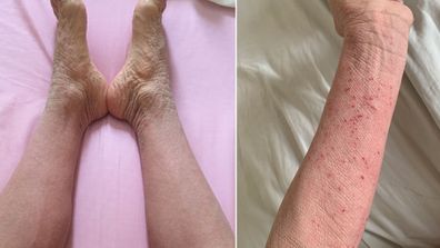 Susan Describes her skin now as 'Elephant skin', it is stronger but shows signs of damage.