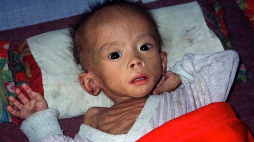 A malnourished child lying at a baby home in Pyongsong City, North Korea.
