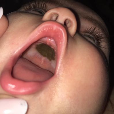 Mum mortified to discover what mystery mark on daughter's mouth was