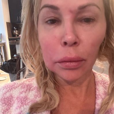 Brandi Glanville menghadapi cacat