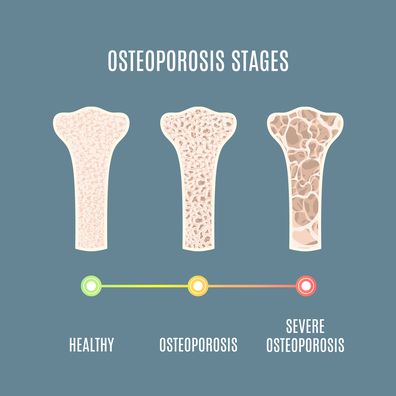 Osteoporosis progress, illustration.