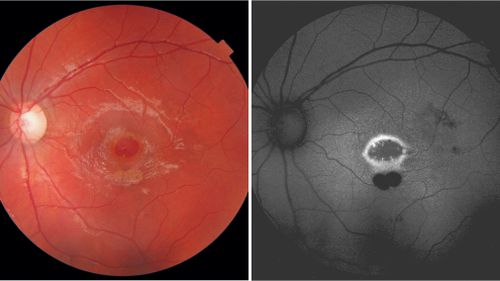 A nine-year-old boy burned a hole in his eye's retina after staring into a green laser pointer and almost sending himself blind. Picture: New England Journal of Medicine.