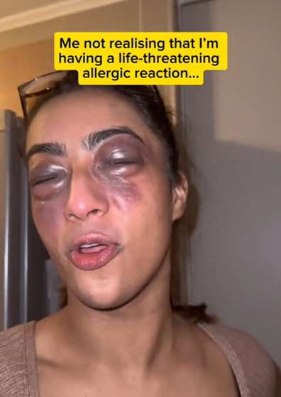 Influencer filmed a TikTok instead of going to the hospital for allergic reaction