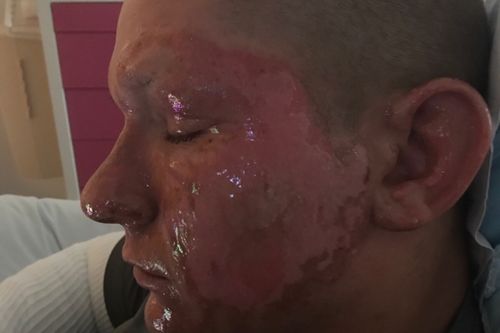 Alex Childress' brush with Hogweed caused the skin on the side of his face to melt away. Picture: Supplied