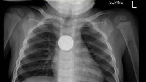 Australian medical professionals have issued an urgent warning to parents following a sharp rise in the number of young children swallowing button batteries. 