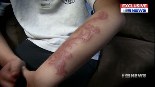 There have been a string of cases involving tourists, mostly children, getting burns from henna tattoos in Bali. Picture: 9NEWS