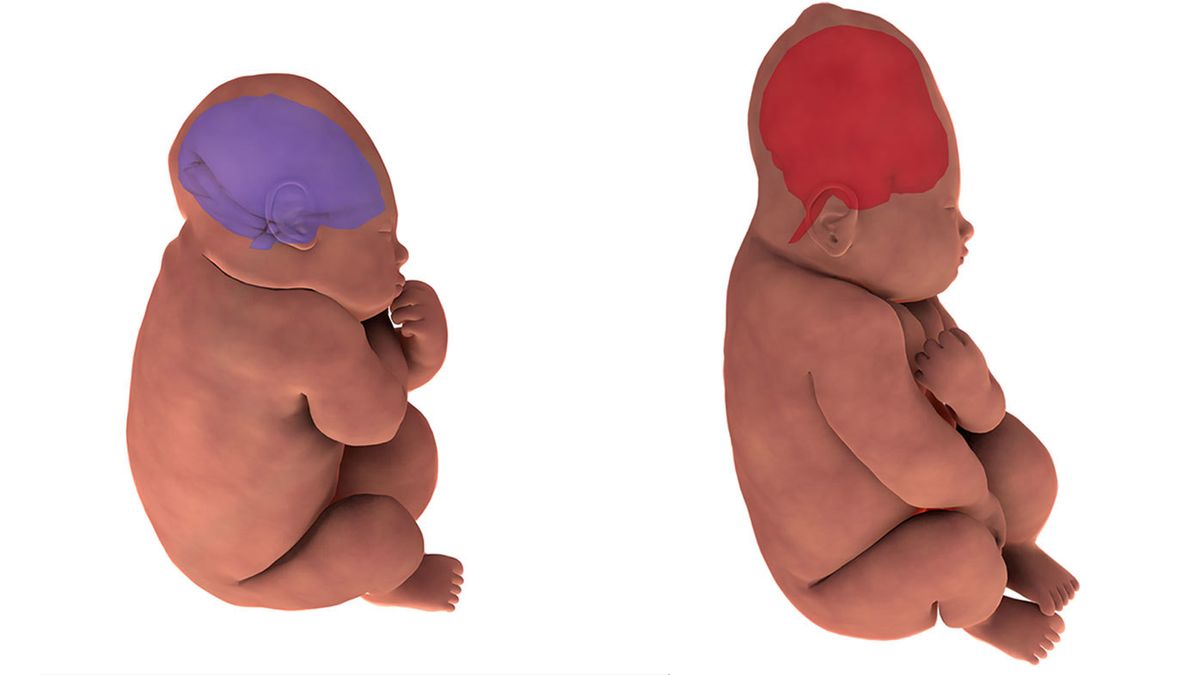 Foetal head moulding: How a baby's skull changes shape during birth - 9Coach