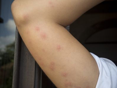 bedbug bites