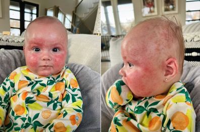 Five-month-old Palmer has a serious cow's milk allergy that causes these painful rashes. 