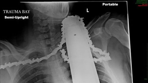 Chainsaw lodges in tree chopper's neck