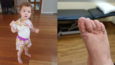 Left: Daisy, Right: Daisy's foot with friction burn.