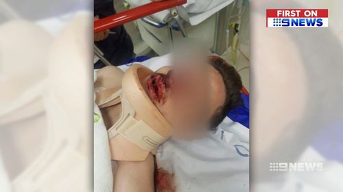 The 18-year-old suffered a broken nose, fractured cheekbone and lost a tooth.