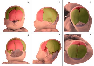 Foetal head moulding