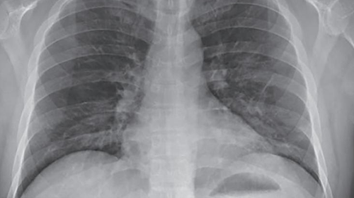 This file images shows pneumonia in a coronavirus patient's lungs.