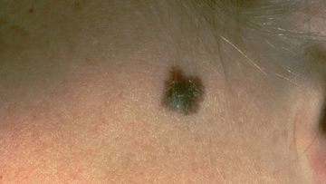 This photo, provided by the American Academy of Dermatology, shows a typical presentation of a suspicious mole that eventually was diagnosed as melanoma. 