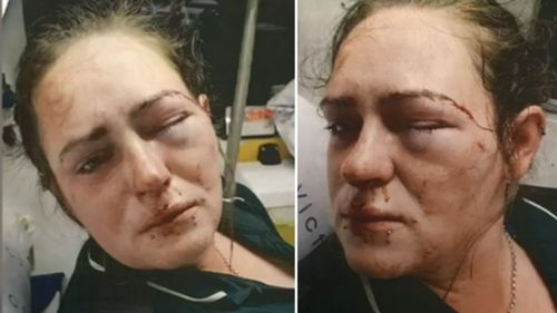 The 23-year-old's eye socket was broken in the alleged road rage incident.