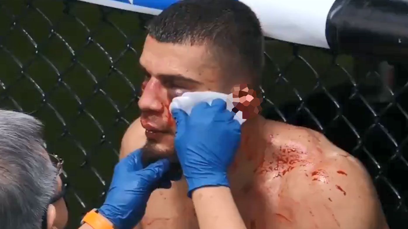 UFC debutant Ramiz Brahimaj&#x27;s early is badly torn. (Twitter)
