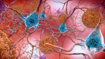 Cells in an Alzheimer&#x27;s affected brain