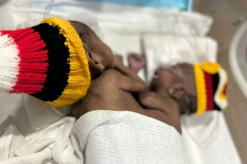 O﻿ne of the conjoined twins who were flown from Papua New Guinea to Australia in a desperate attempt to save them has died following an emergency surgery. 