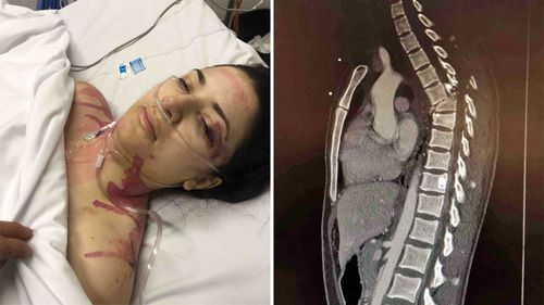 Christina Vithoulkas, 23, severed her spinal cord in the accident.